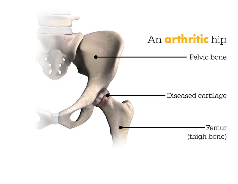 Diagram of arthritic hip